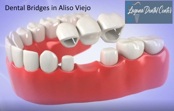 Dental Bridge in Aliso Viejo