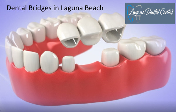 Dental Bridge in Laguna Beach