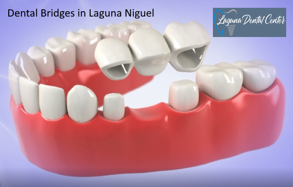 Dental Bridge in Laguna Niguel