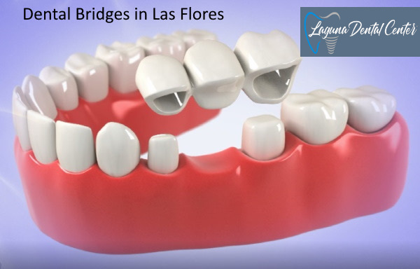 Dental Bridge in Las Flores