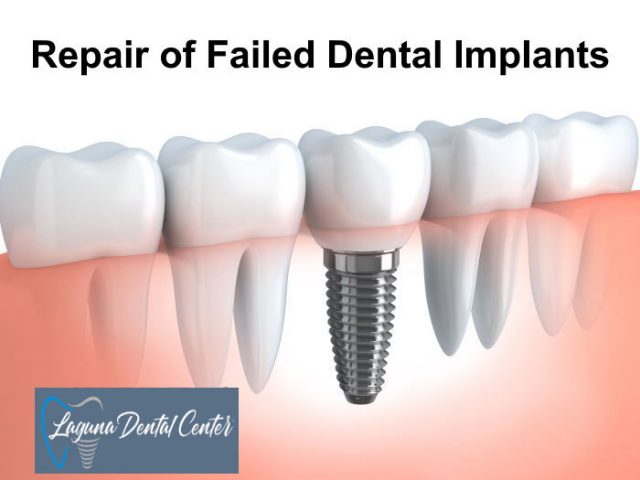 Dental Implant Repair
