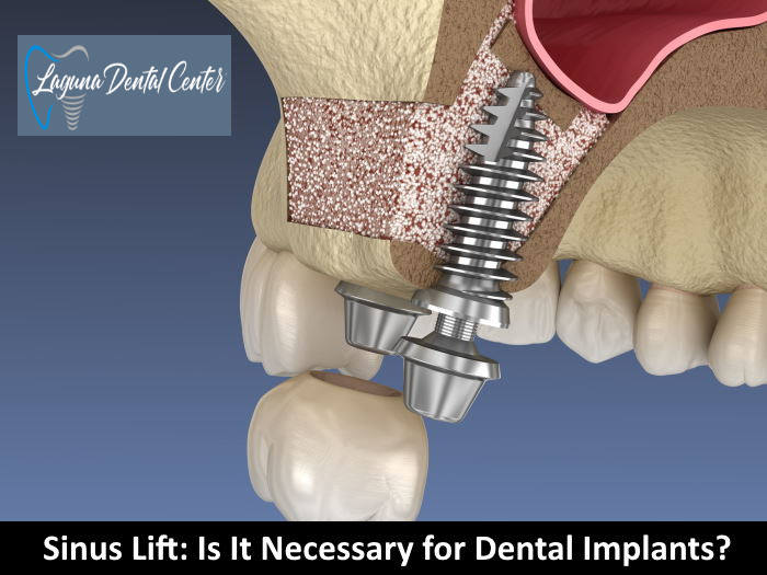 Sinus Augmentation for Dental Implants