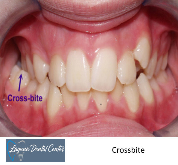How Do Invisalign Attachments Help With Your Treatment? - Laguna Dental  Center