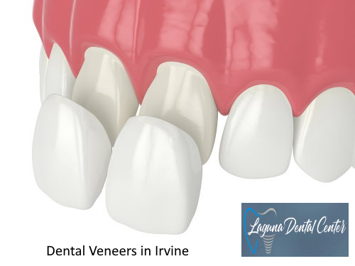 Dental Veneers in Irvine