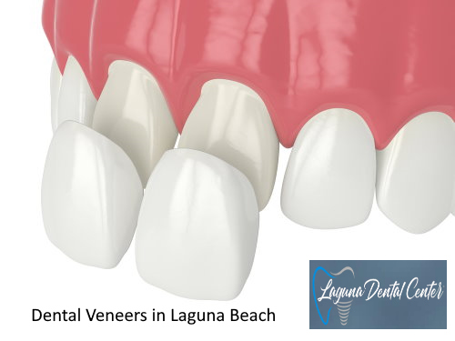 Dental Veneers in Laguna Beach