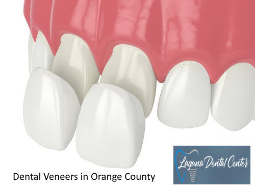 Dental Veneers in Orange County