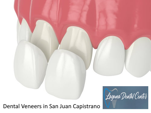 Dental Veneers in San Juan Capistrano