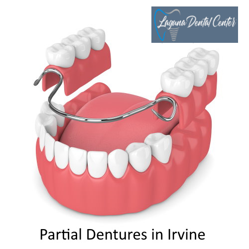 Partial Dentures in Irvine