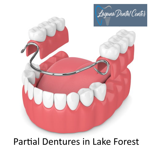 Partial Dentures in Lake Forest