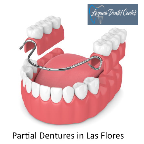 Partial Dentures in Las Flores