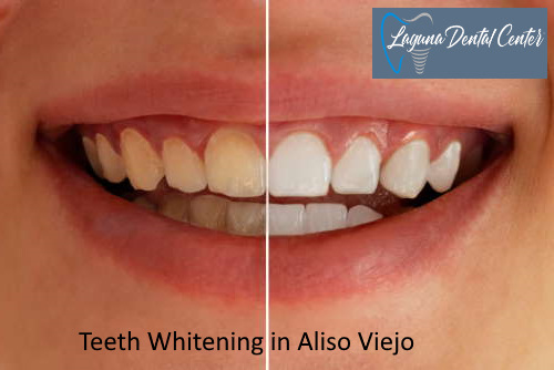Teeth Whitening in Aliso Viejo