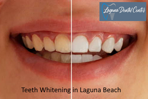 Teeth Whitening in Laguna Beach