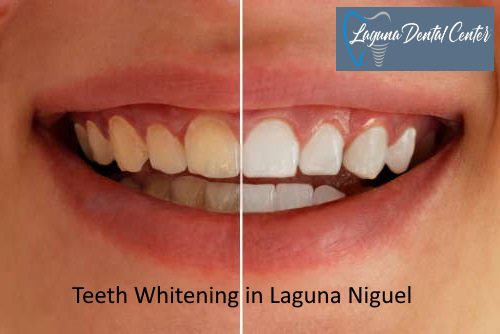 Teeth Whitening in Laguna Niguel
