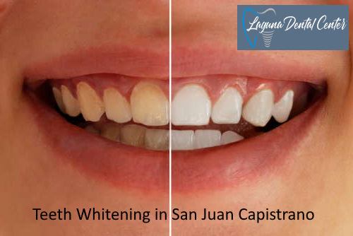 Teeth Whitening in San Juan Capistrano