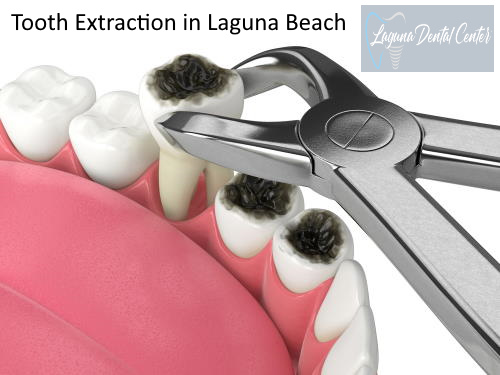Dental Extraction in Laguna Beach