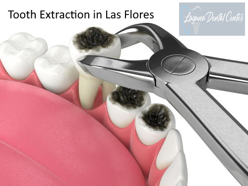 Dental Extraction in Las Flores