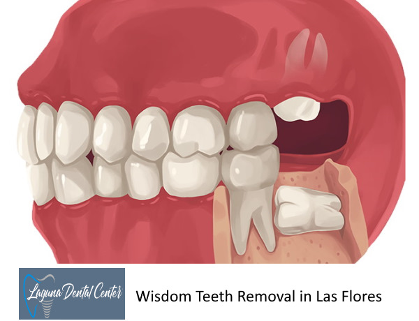 Wisdom Teeth Extraction in Las Flores