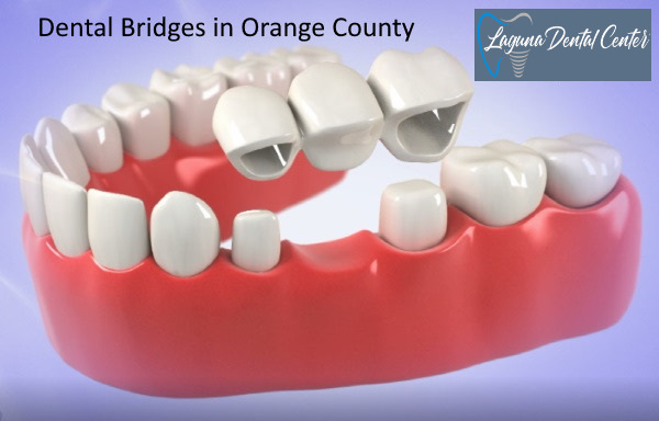Dental Bridge in Orange County