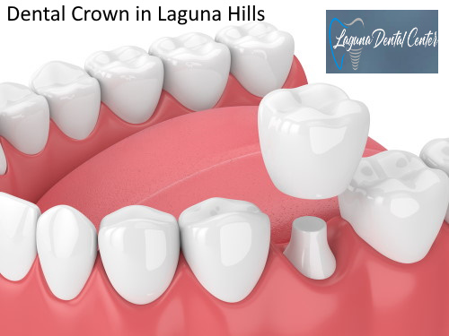 Dental Crowns in Laguna Hills