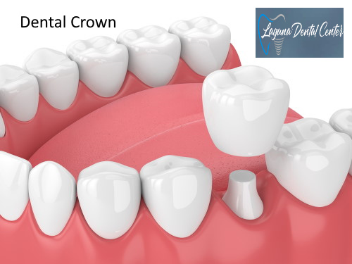 How Much are Tooth Crowns: Affordable Costs & Options