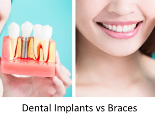 Dental Implants vs Braces – Which Should Be First?