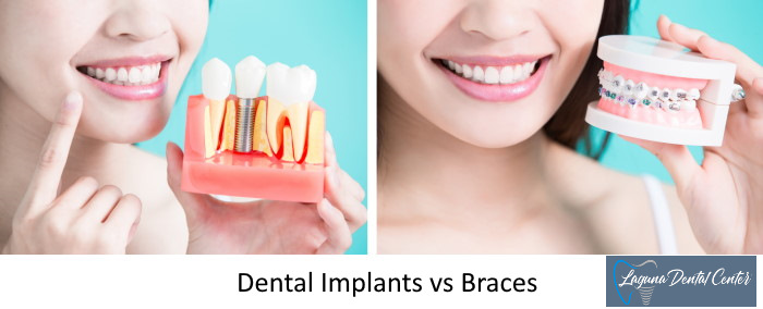 Dental Implants vs Braces