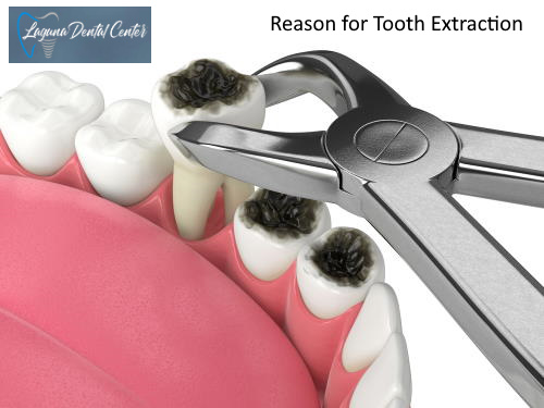 Reasons for Tooth Removal