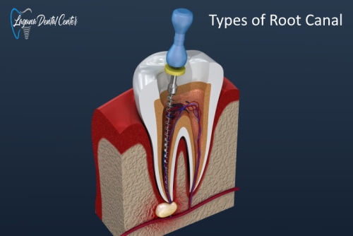 Different Types of Root Canal Treatment