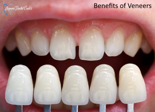 Benefits of Veneers
