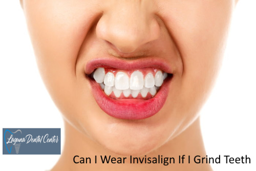 Can I Wear Invisalign If I Grind Teeth