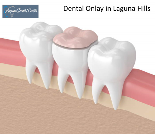 Dr. Ronald Ayzin Dental Onlay Provider for Laguna Hills community