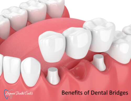 5 Tooth Bridge Advantages