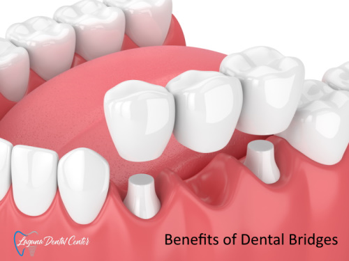 Advantages of dental bridges