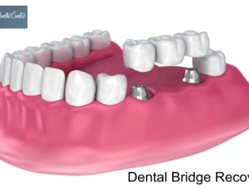 Dental Bridge Recovery