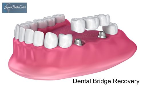 Dental Bridges Aftercare