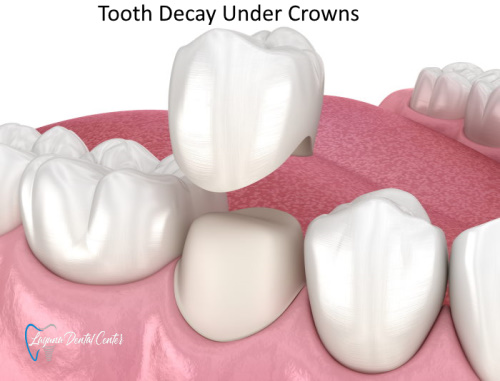 How to Detect Decay Under Dental Crown
