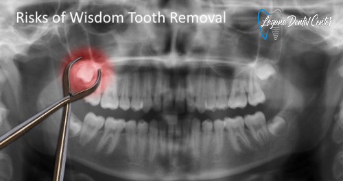 Risks of Wisdom Tooth Removal
