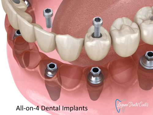 All-on-4 Dental Implants Cleaning