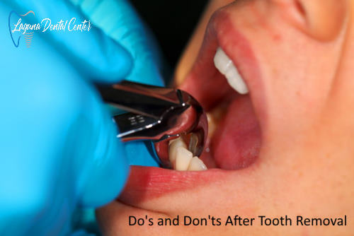 Do's and Don'ts After Tooth Removal
