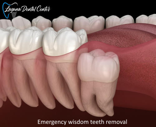 Emergency wisdom teeth removal in Laguna Hills
